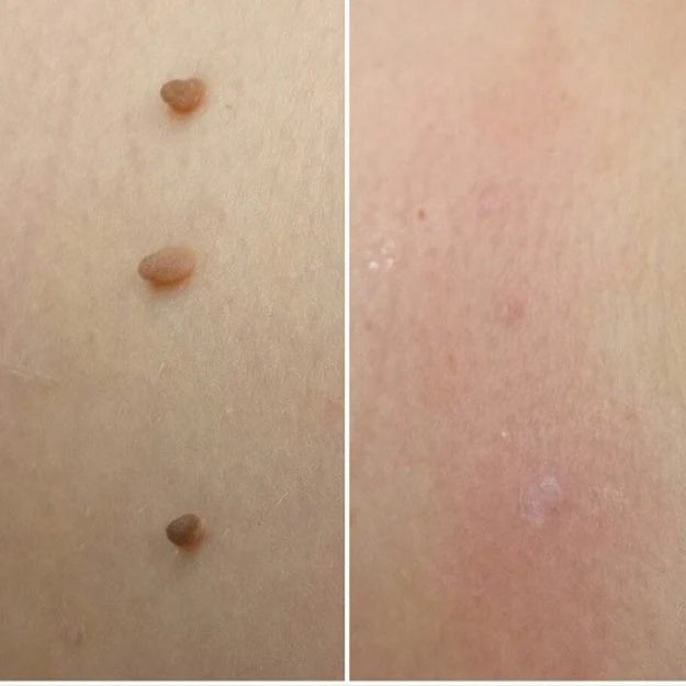 MyPeau™ Acabaram-se as marcas na pele!