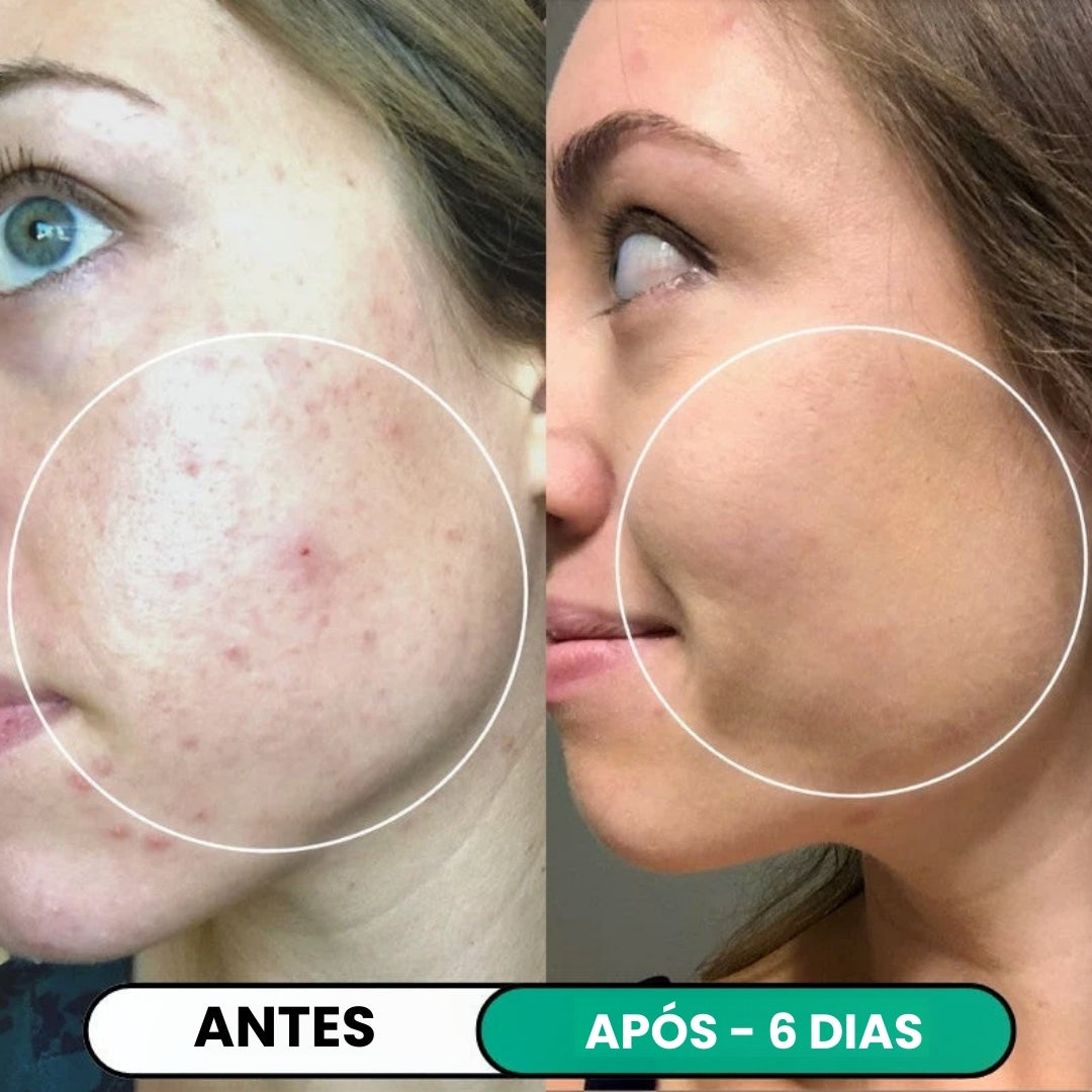 Tratamento Anti-Imperfeições® de Alta Frequência