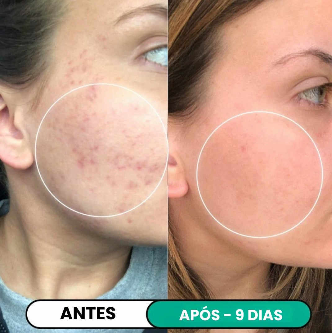 Tratamento Anti-Imperfeições® de Alta Frequência