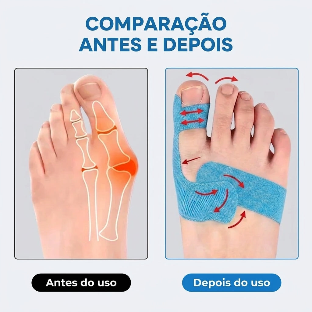 Embalagem com 10 - OrthoFlex – Fita para Hálux Valgo