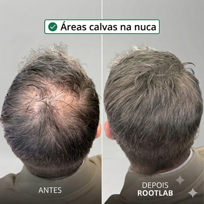 Sistema de crescimento capilar Apex