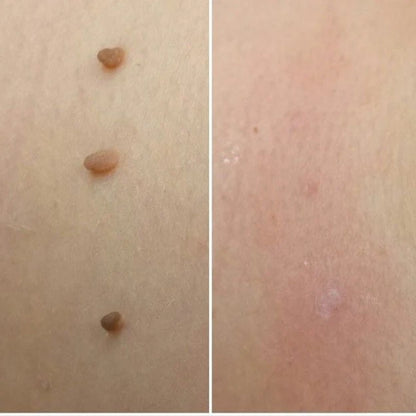 MyPeau™ Acabaram-se as marcas na pele!