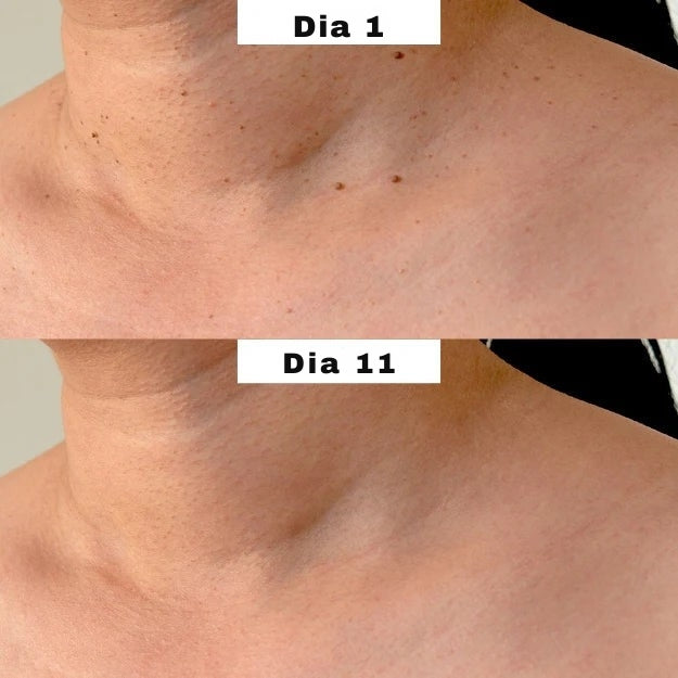 MyPeau™ Acabaram-se as marcas na pele!
