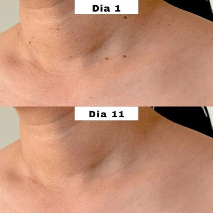 MyPeau™ Acabaram-se as marcas na pele!