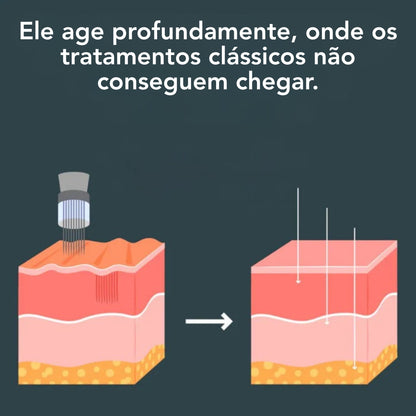 Sistema de Microinfusão™