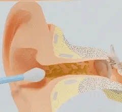 WaxClean™ | Limpeza inteligente dos ouvidos com tecnologia avançada